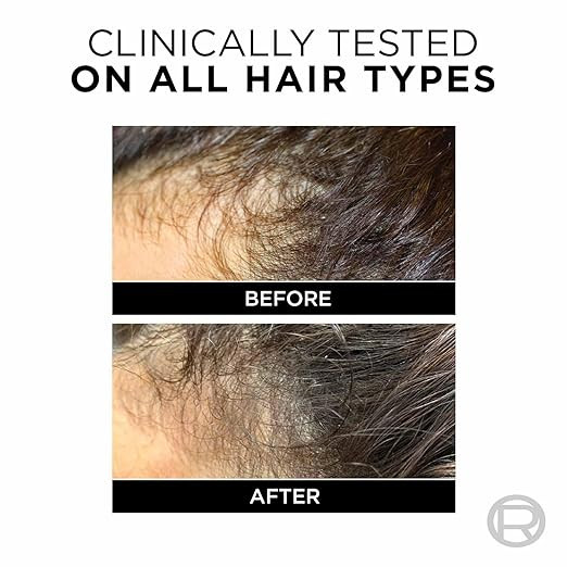 L'Oreal Paris Anti-Hair Fall Shampoo, Reinforcing & Nourishing for Hair Growth, For Thinning & Hair Loss, With Arginine Essence and Salicylic Acid, Fall Resist 3X, 180 ml